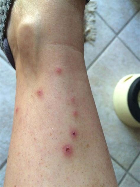 Are These Bed Bug Bites Allergy Skin Blood Swelling H - vrogue.co