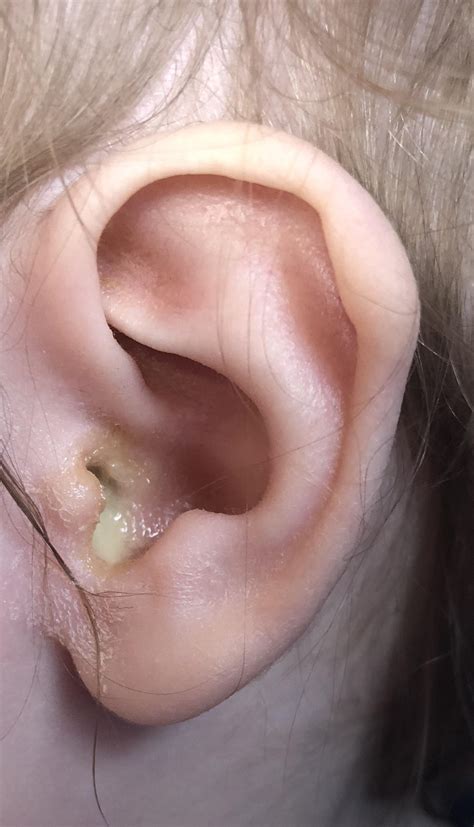My toddler’s ear (already been to urgent care and got treatment) : r ...