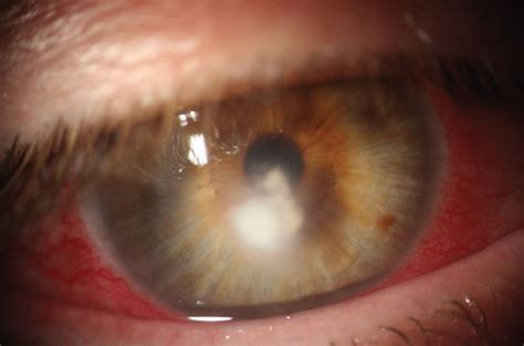 Case Report: Severe Dietary Restriction Leads to Fungal Keratitis