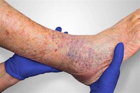 Venous Ulcers – Diagnosis and Treatment - Laser Vein Clinic