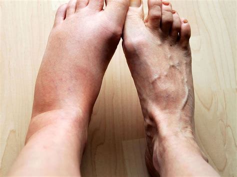 How Is Inflammation Involved in Swelling? | Britannica