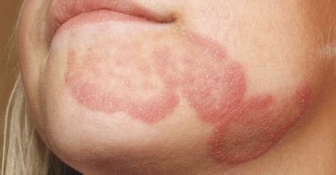 Tinea Unguium Causes, Symptoms, Diagnosis and Treatment - Natural Health News