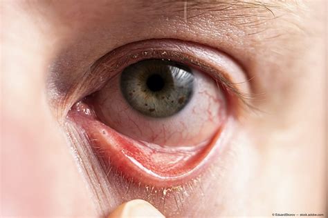 Allergic Conjunctivitis - Axis Eye Clinic