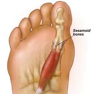 Sesamoiditis Symptome & Behandlung - My FootDr | Guinguette Marais Poitevin