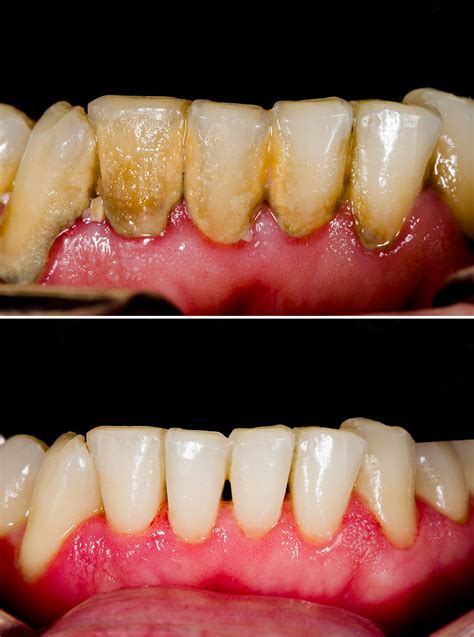 Periodontal Disease (Gum Disease) - Tuxedo Dental Group