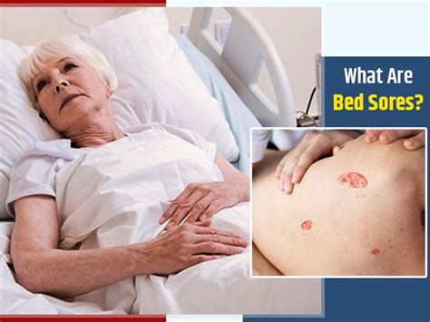 Bed Sores: Know Symptoms, Causes And Risk Factors For This Skin ...