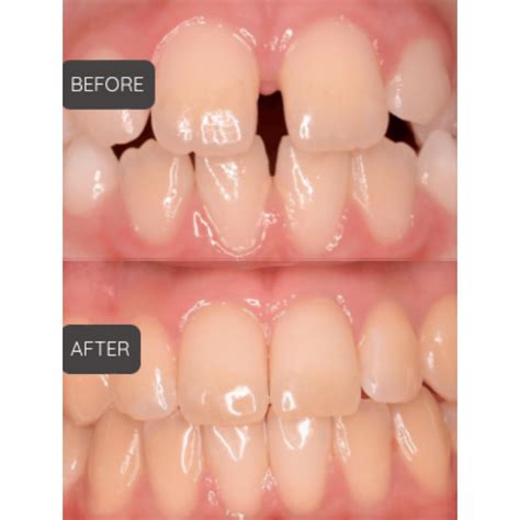 Before and After | Dental Spa of Artesia