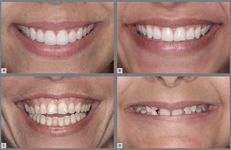 SciELO - Brasil - The smile arc: review and synthesis The smile arc: review and synthesis