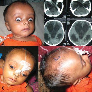 (PDF) Result of Endoscopic Third Ventriculostomy for Hydrocephalus Caused by Cerebral Aqueductal ...