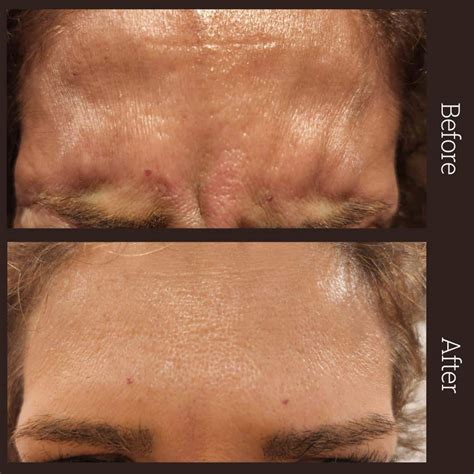 Before & After Botox | Dermatouch | Richmond Hill Botox Clinic