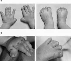 Medical Treatment Pictures-for Better Understanding: Achondroplasia ...