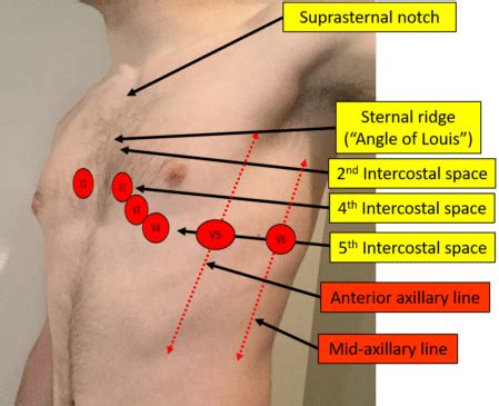 Proper Electrocardiogram (ECG/EKG) Lead Placement | ECGEDU