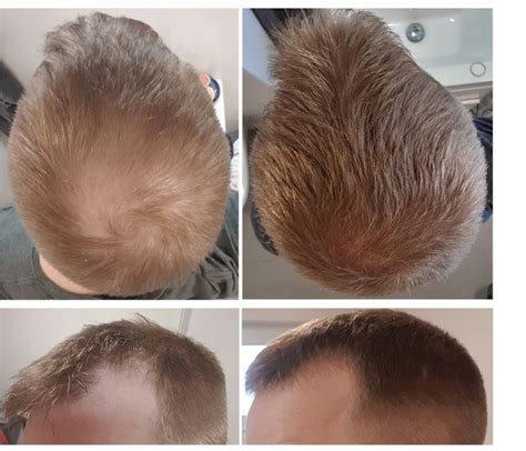 Does Finasteride Regrow Hair? - Expert Review - Wimpole Clinic