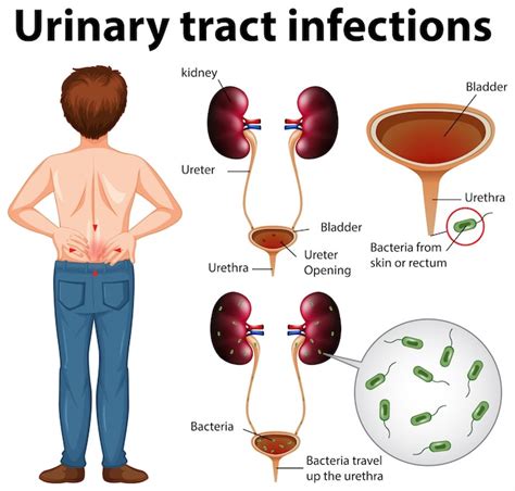 Illustration Informative Des Infections Des Voies Urinaires | Vecteur Premium