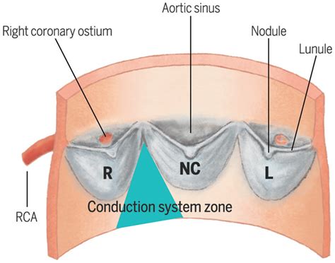 Spatial relationship between the three cusps of the aortic valve and ...