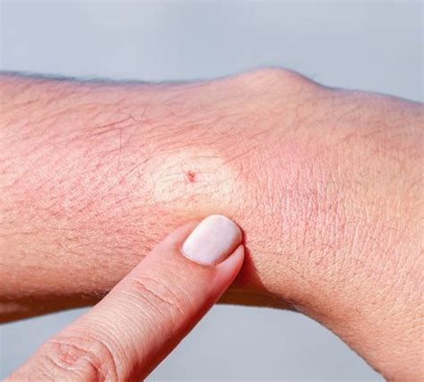 So You Have a Bug Bite. See 19 Common Bites—and How to Properly I.D. Them | Insect bites and ...