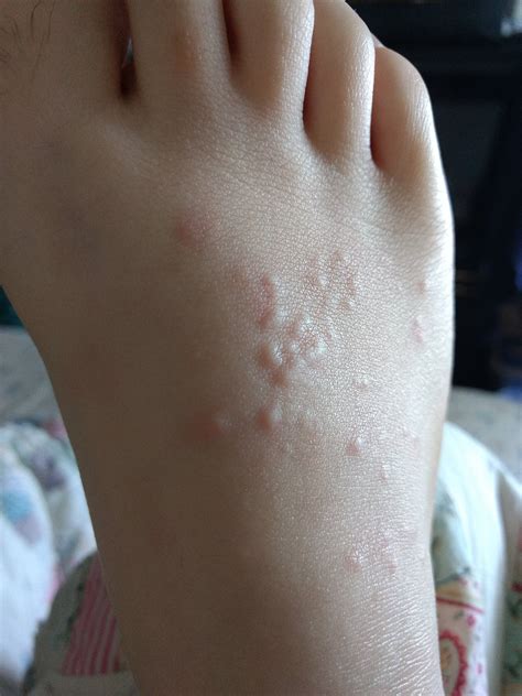 small bumps on top of foot : AskDocs