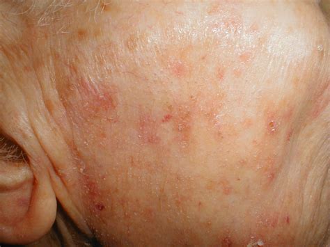 Actinic keratosis - Pictures, Causes, Symptoms and Treatment