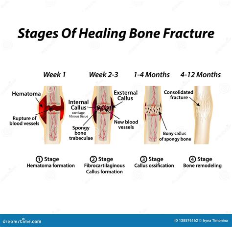 Stages of Healing Bone Fracture. Formation of Callus. the Bone Fracture ...