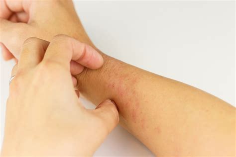 Pruritus therapies: What you’ve been itching to know | Dermatology ...