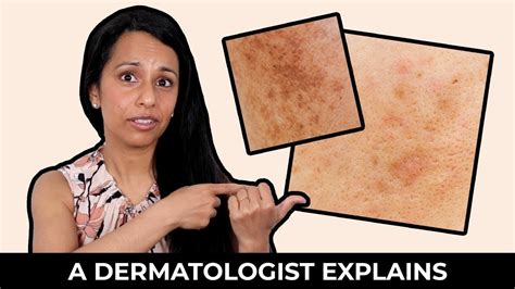 What is Post-Inflammatory Hyperpigmentation? | How to Treat Post ...