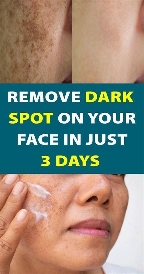 Simple Trick to Remove Brown Spots from Your Skin | Remove dark spots ...