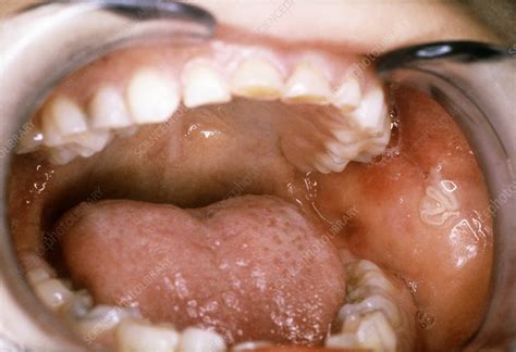 Blocked Salivary Gland Duct