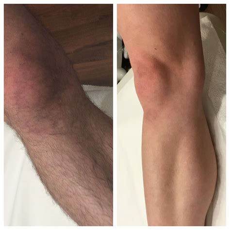 Laser Hair Removal Legs Before And After