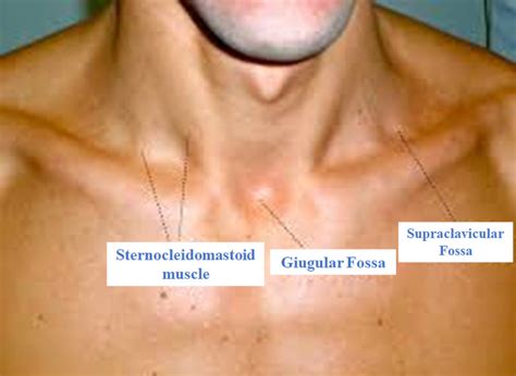 [Figure, The image shows the supraclavicular...] - StatPearls - NCBI Bookshelf