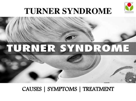 Turner syndrome : causes, symptoms and treatment