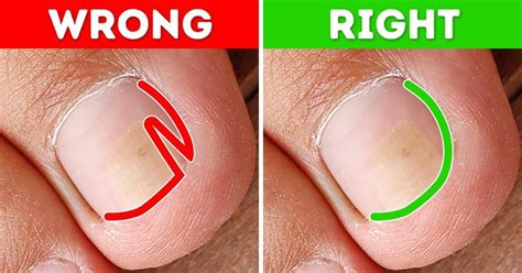 ingrown toenails treatment