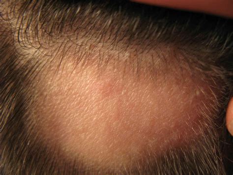 Explainer: what causes alopecia areata and can you treat this type of hair loss?