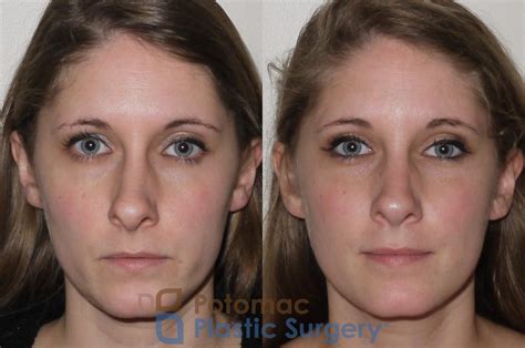 Rhinoplasty - Medical Before & After Photos Patient 104 | Washington DC ...