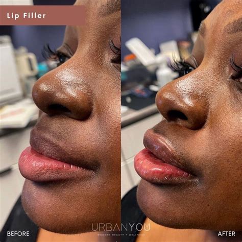 Lip Filler | Before and After | Lip fillers, Face fillers, Lips