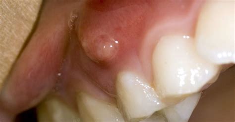 Gum boils: What they are and how to treat them