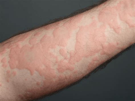 Fibromyalgia Rash (Causes and Treaments) – Alive Market