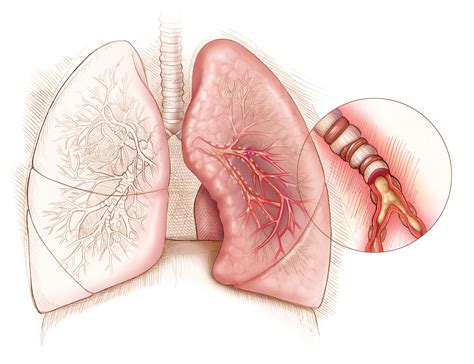 Update on Asthma Management: the 2022 GINA Report