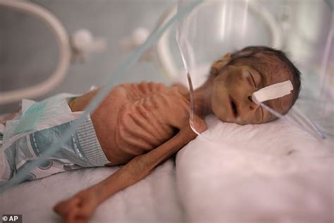 Malnourished baby boy pictured in Yemeni hospital reveal devastating ...