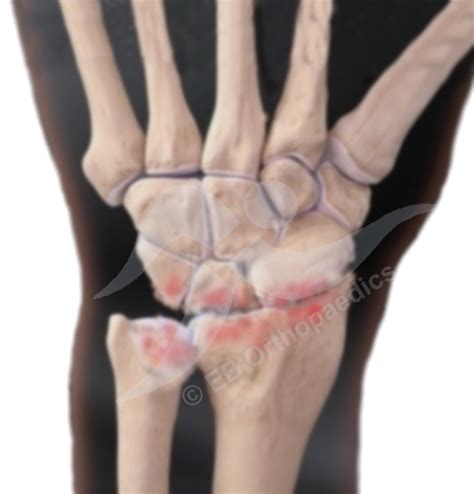 Orthopaedic & Trauma Surgeon - Wrist - Wrist arthritis