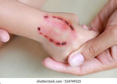 Human Bite Wound Photos and Images | Shutterstock