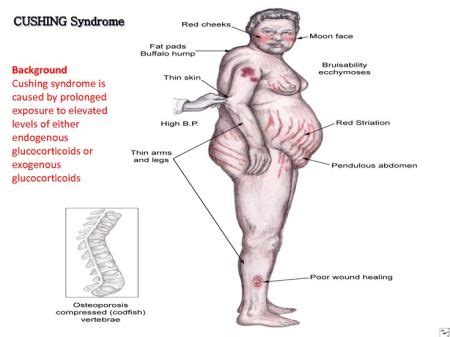 Treatment for Cushing's Disease | Cushing's Disease Treatment