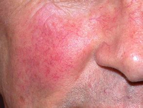 Liver Disease Itchy Skin Rash