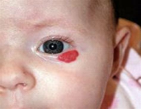 Infantile Hemangioma Flashcards | Quizlet