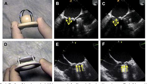 Figure 6 from Mitral prosthetic valve assessment by echocardiographic guidelines. | Semantic Scholar