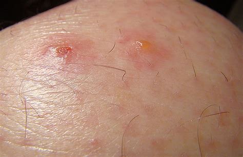Trombicula mite sores | Flickr - Photo Sharing!