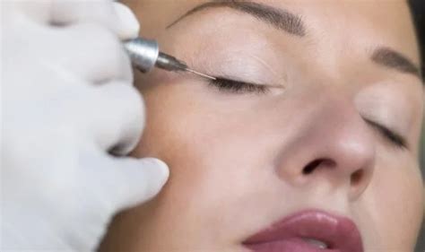 Eyeliner Tattoo Removal Types And How Does They Works