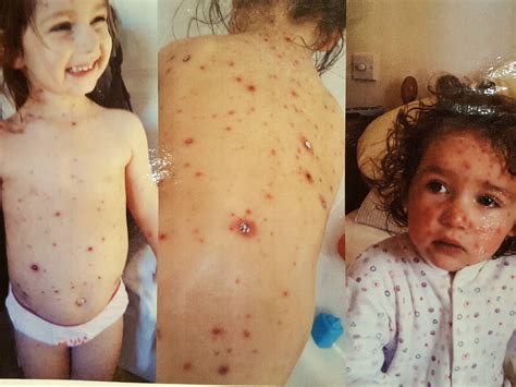 My child has chicken pox for the second time - Child Matters