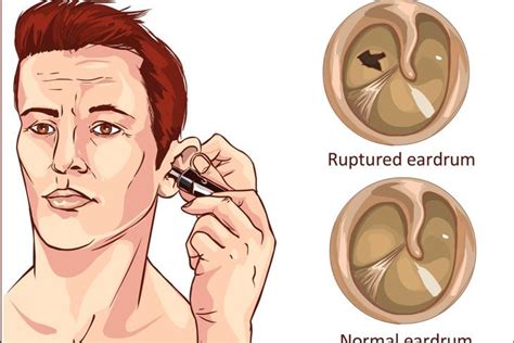 Causes and Treatments for Eustachian Tube Dysfunction - Facty Health