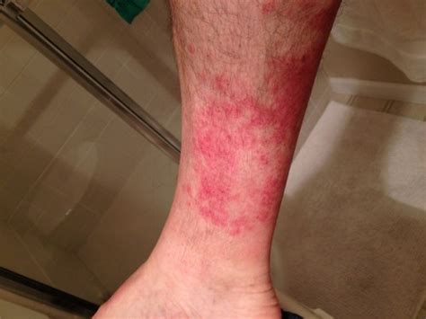 Hiker's rash: red rash between knee and ankle after hiking for several ...