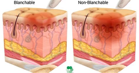 Icd 10 Cm Code For Pressure Ulcer Of Gleteal Cleft